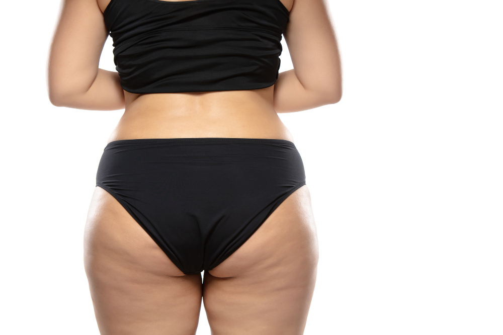 The Ultimate Guide to Tackling Cellulite with Cryoskin in Lake Mary, FL