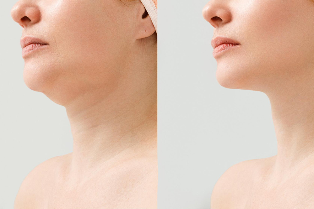 Effective Solutions for Double-Chin Woes